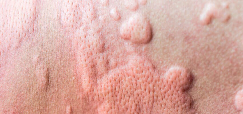 Best skin allergy doctor in hyderabad